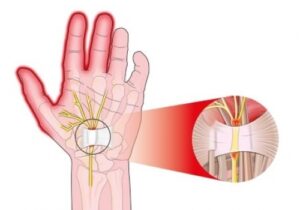 Karpal Tünel Sendromu Belirtileri Karpal Tünel Sendromu Belirtileri