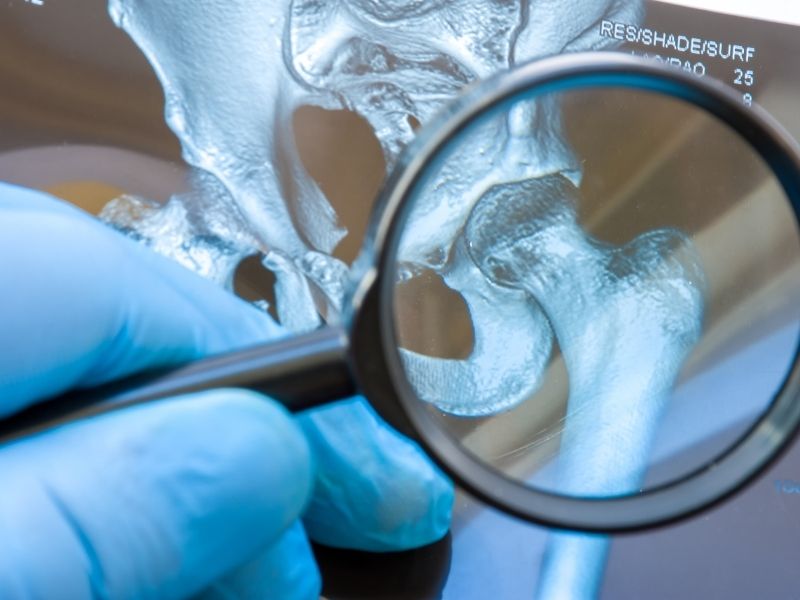 kalça kireçlenmesi