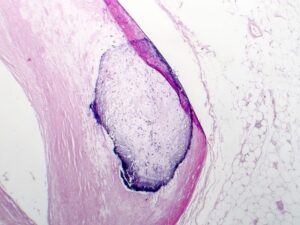 Kalça Kireçlenmesi Belirtileri kalça kireçlenmesi belirtileri