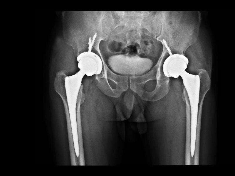 Kalça Protezi Nedir?