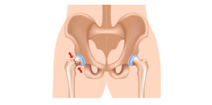 yaşlı hastalarda kalça kırığı