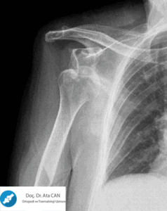 humerus kırıkları