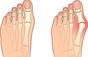 Halluks Valgus Dereceleri