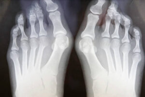 Halluks Valgus Dereceleri