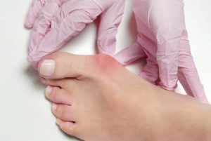 Halluks Valgus Ameliyatı Sonrası