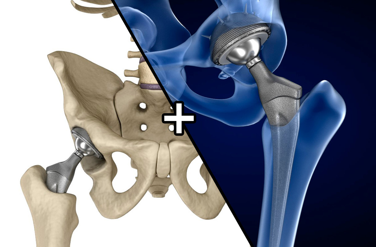 Total Hip Replacement Surgery Total Kalça Protezi Ameliyatı