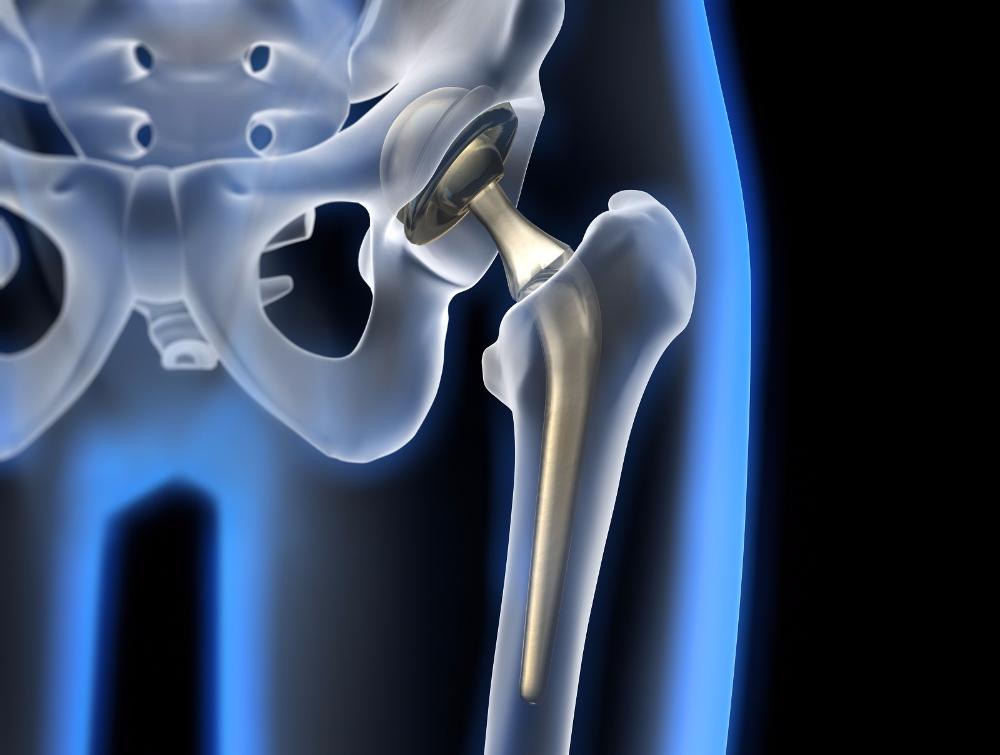 Hip Dislocation Treatment Kalça Çıkığı Tedavisi