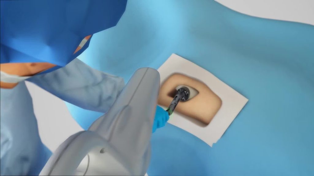 Robotik Kalça Protezi