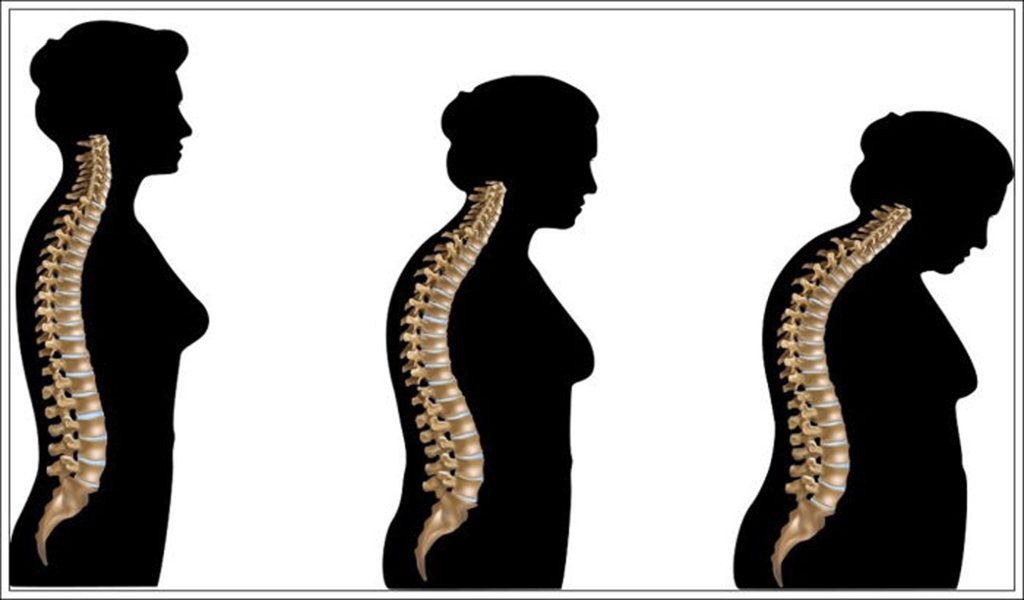 Osteoporozda Beslenme ve Egzersizin İyileştirici Gücü: Kemiklerinizi Nasıl Korursunuz?