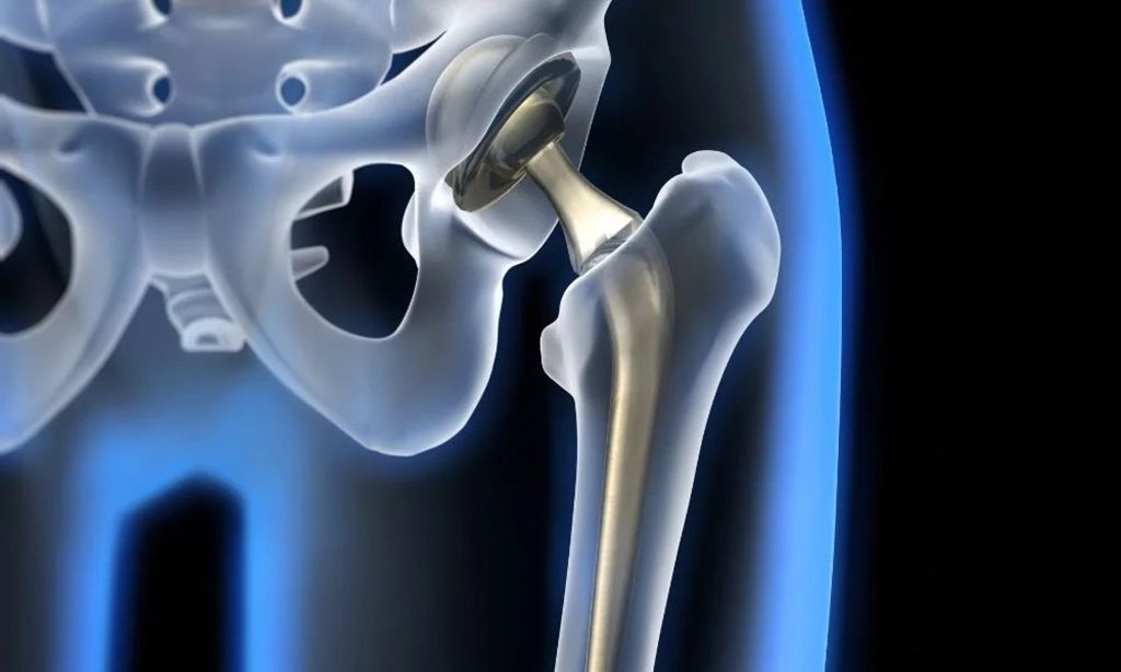 Robot Teknolojisi ile Kalça Protezinde Maksimum Hareket