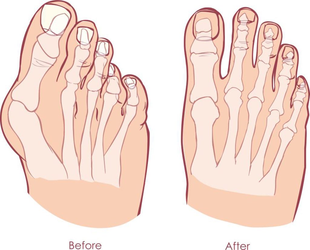 Halluks Valgus