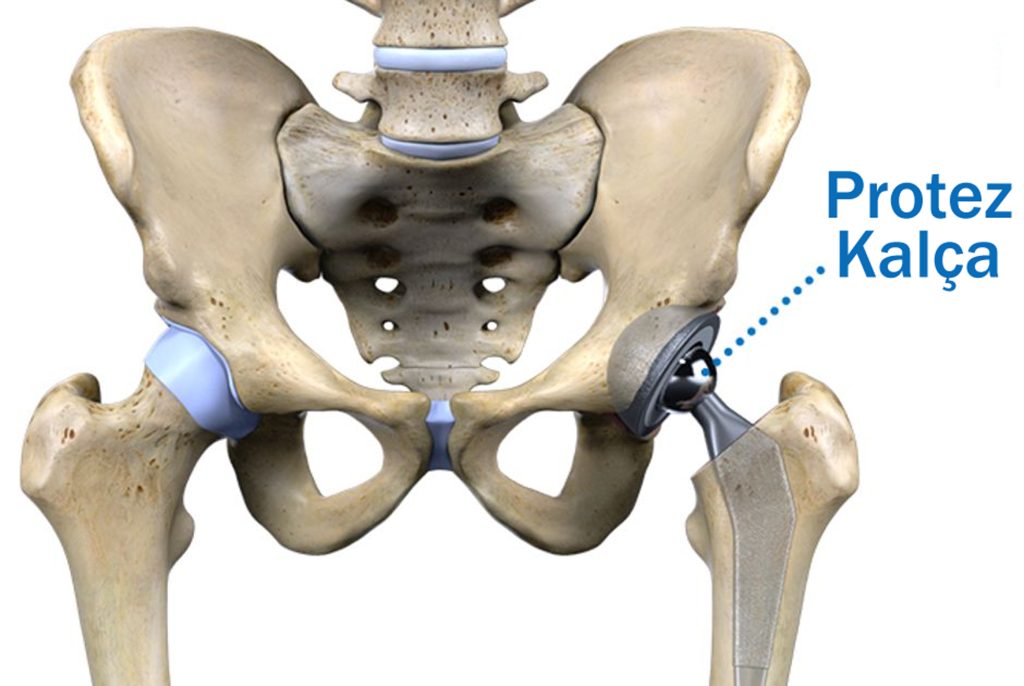 Kalça Protezi