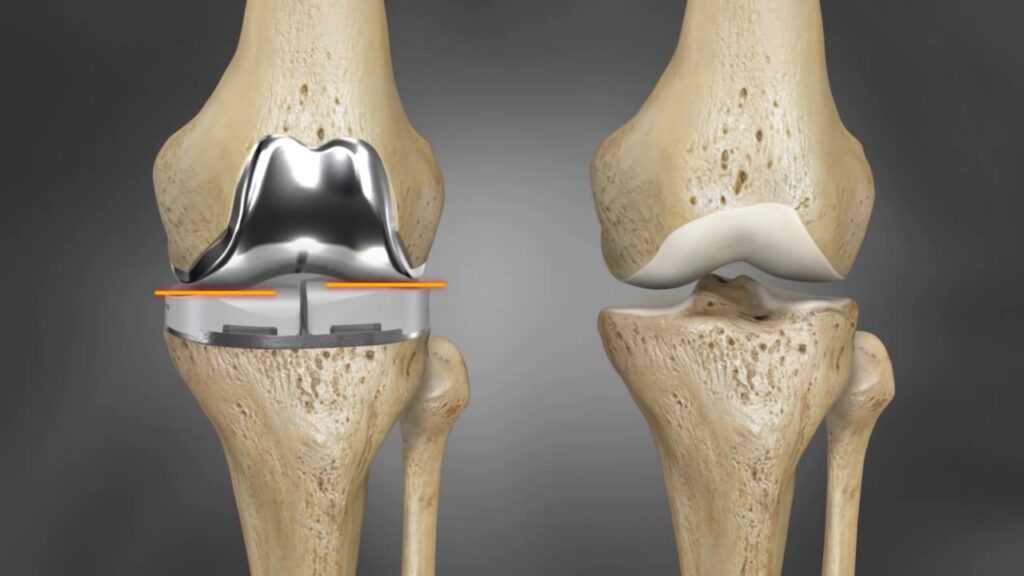 Blog Knee Replacement Surgery