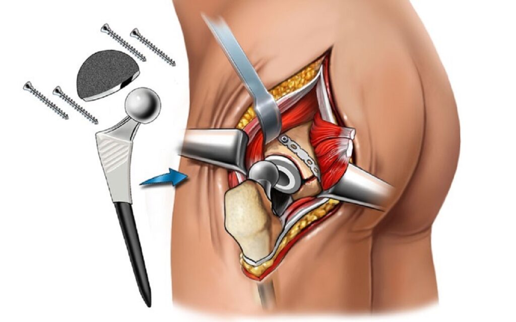 Blog Total Hip Replacement Surgery